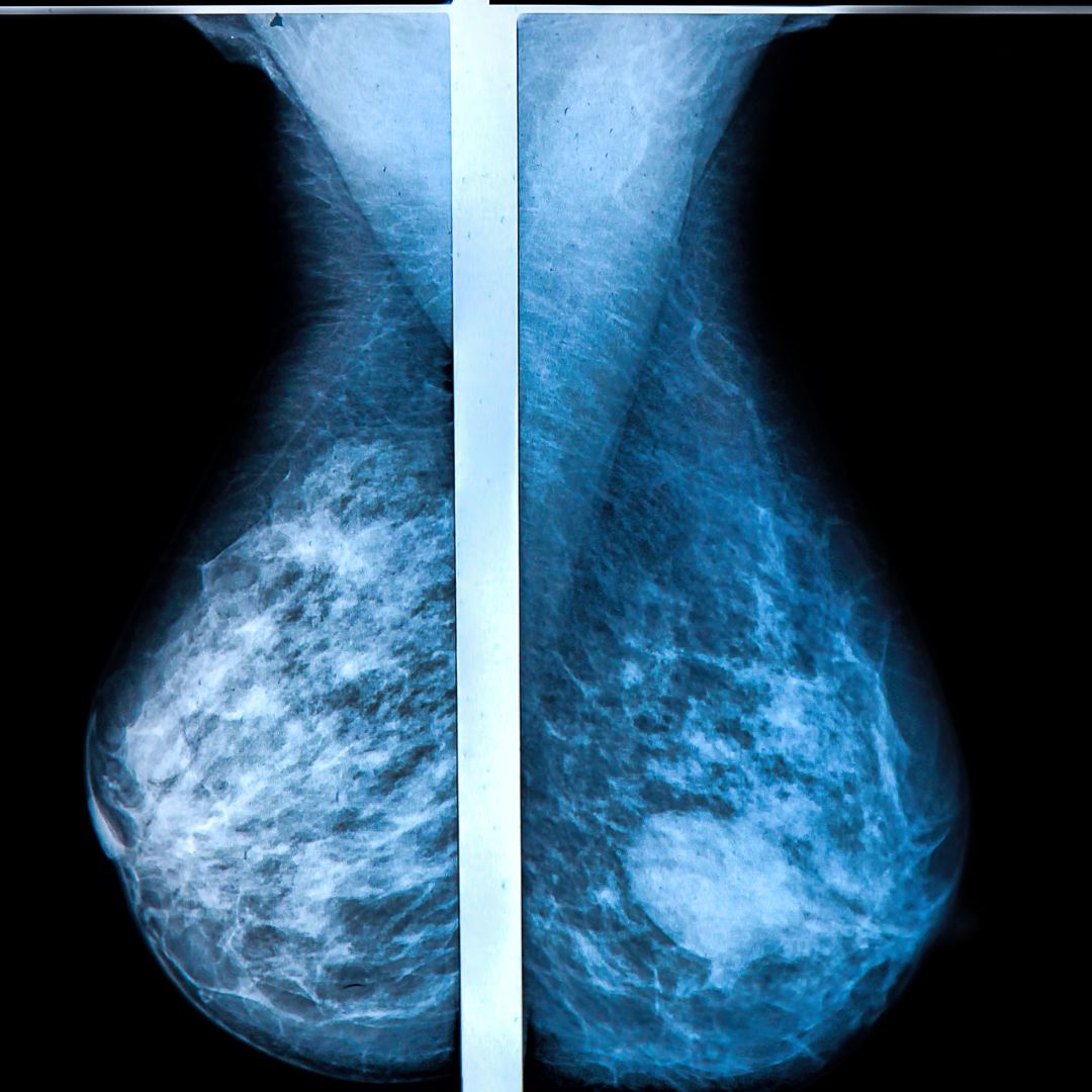 The Truth About Mammograms: How Often You Should Schedule Them For Early Detection