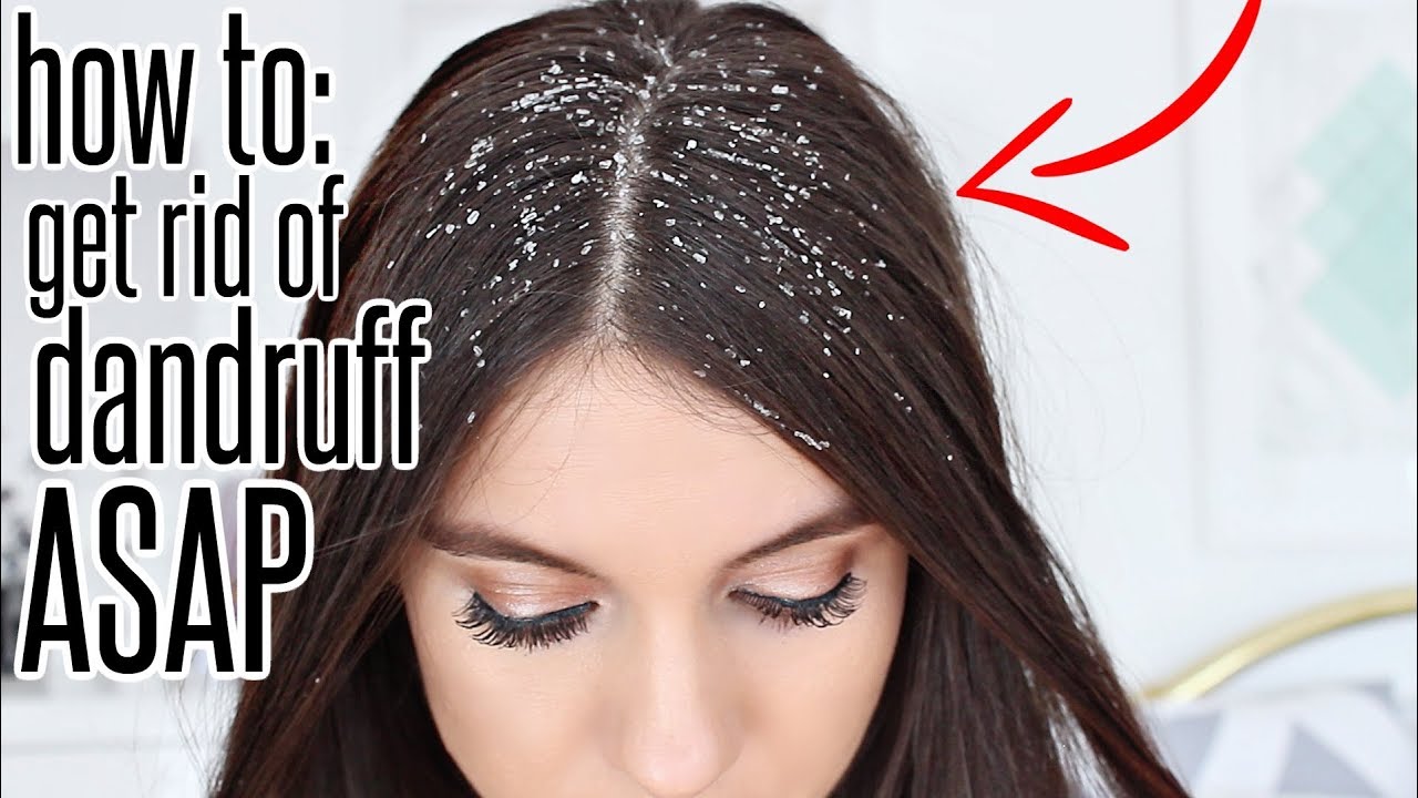 Dandruff Demystified: The Ultimate Guide To Banish It For Good
